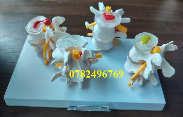 mô hình giải phẫu bệnh lý đốt sống