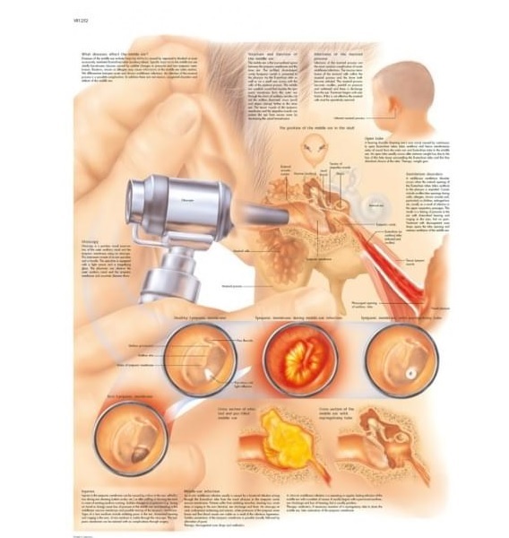 TRANH, BIỂU ĐỒ BỆNH VIÊM TAI GIỮA
