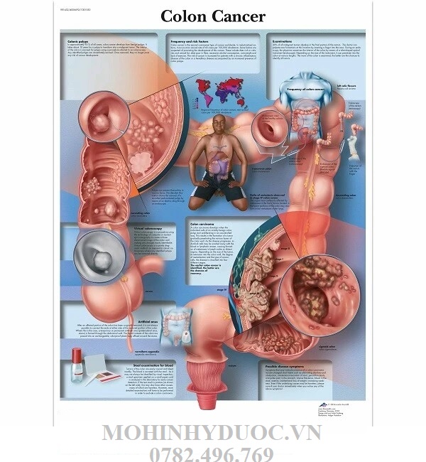 TRANH, BIỂU ĐỒ UNG THƯ RUỘT