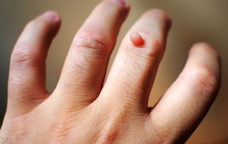 Tìm Hiểu Bệnh Mụn Cóc Là Gì? Nguyên Nhân Gây Ra Và Phương Pháp Điều Trị An Toàn