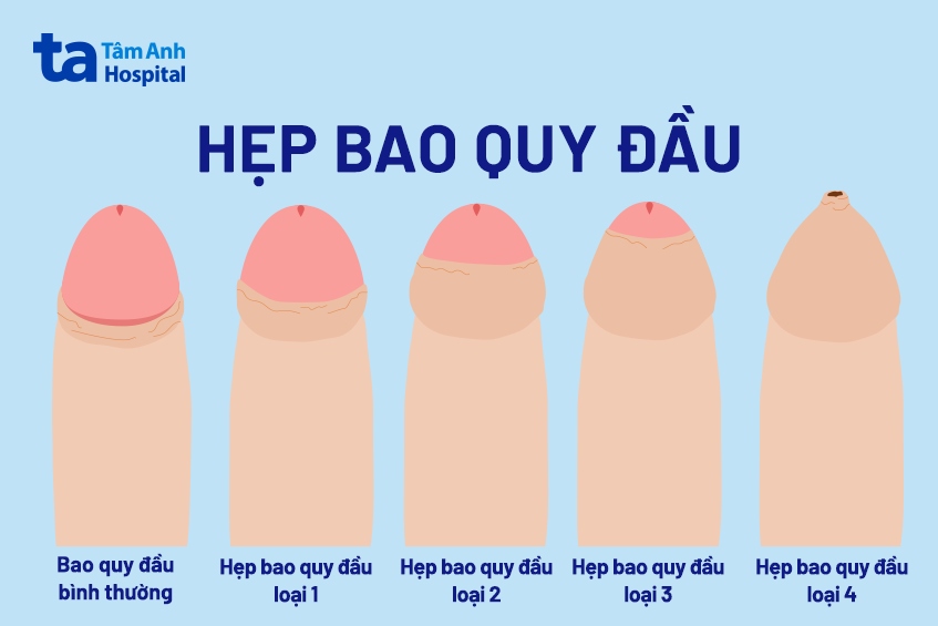 17 Tuổi Chưa Lột Bao Quy Đầu Có Sao Không?
