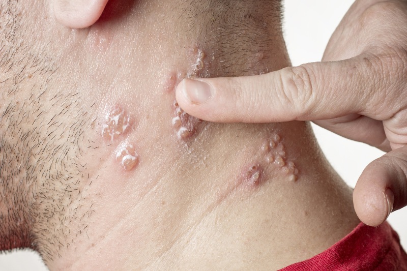 Bệnh Lậu Ở Nam Giới Là Gì? Dấu Hiệu Nhận Biết Sớm Và Cách Phòng Chống Hiệu Quả Nhất