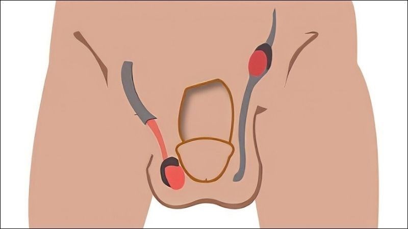 Các Nguyên Nhân Vô Sinh Ở Nam Giới Phổ Biến Hiện Nay – Cập Nhật 2026