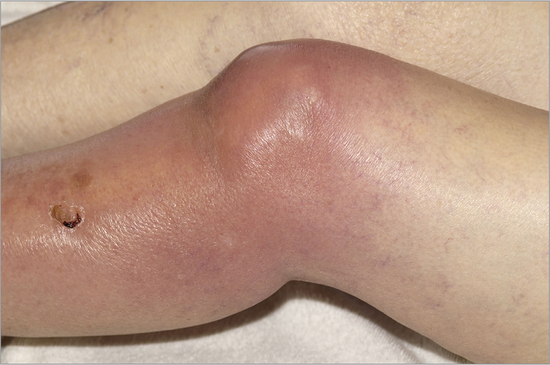 Bệnh Lậu Ở Nam Giới Là Gì? Dấu Hiệu Nhận Biết Sớm Và Cách Phòng Chống Hiệu Quả Nhất