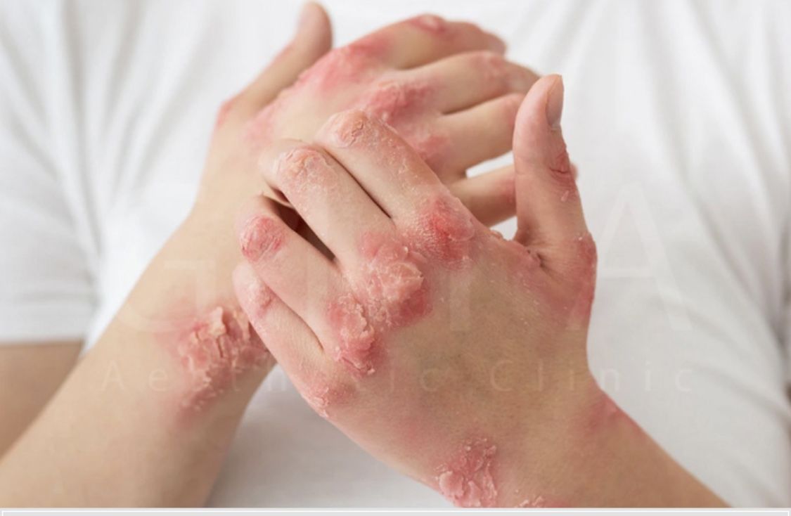 Hôn Nhau Có Lây Bệnh Sùi Mào Gà Không? Sự Thật Là Gì?