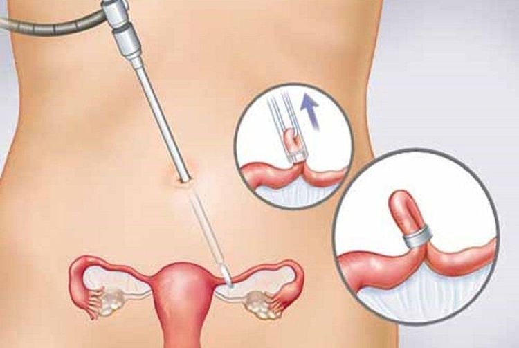 Triệt Sản Nữ Có Nguy Hiểm Không? Sự Thật Về Khả Năng Mang Thai Sau Triệt Sản