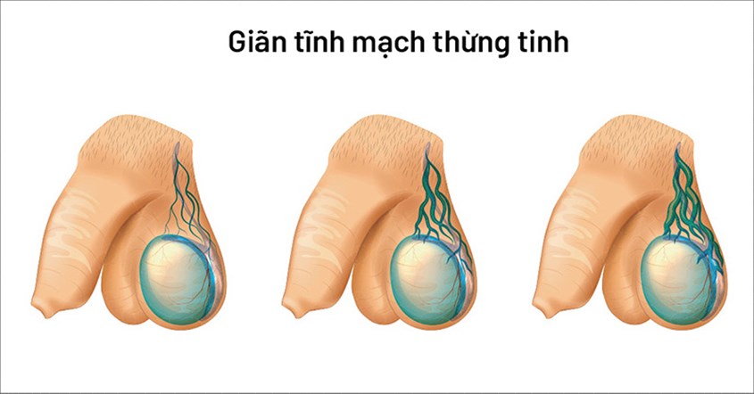 Các Nguyên Nhân Vô Sinh Ở Nam Giới Phổ Biến Hiện Nay – Cập Nhật 2026