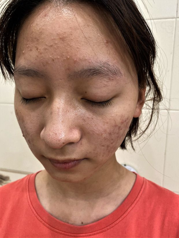 Nuốt tinh trùng có hết mụn không? Sự thật khoa học cần biết