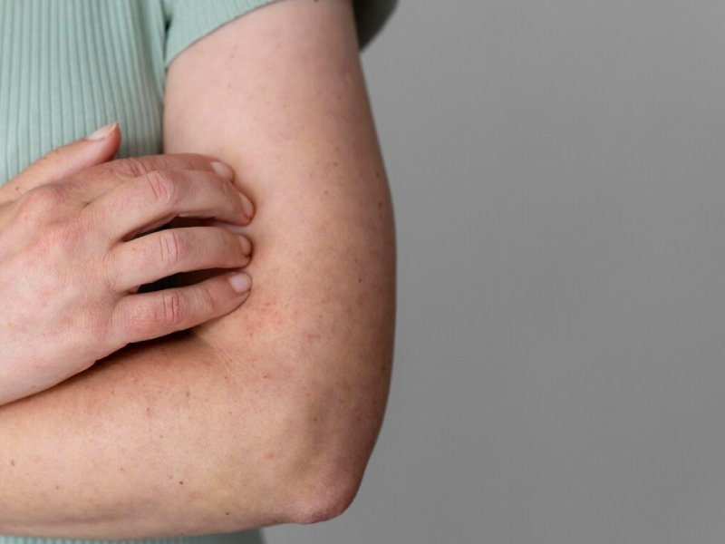 Nhận Biết Dị Ứng Bao Cao Su Như Thế Nào? Mẹo Xử Lý Nhanh Và An Toàn