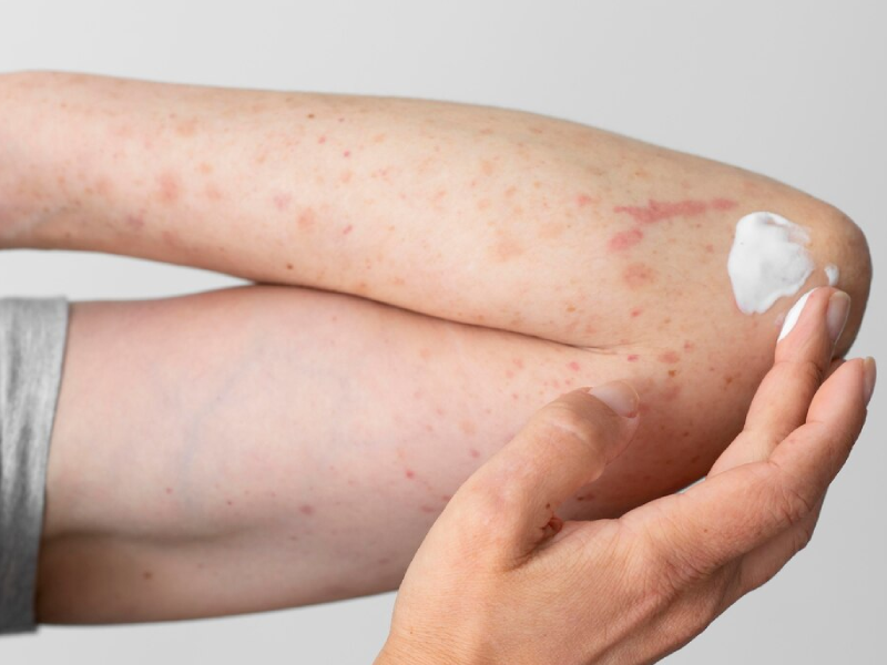 Nhận Biết Dị Ứng Bao Cao Su Như Thế Nào? Mẹo Xử Lý Nhanh Và An Toàn