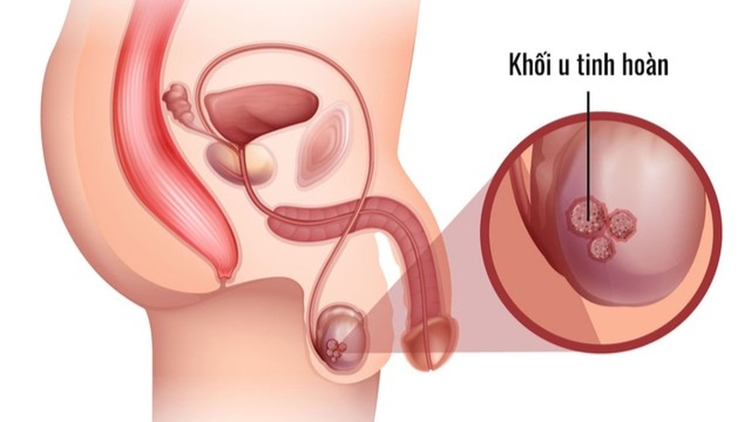 Đặt Tinh Hoàn Nhân Tạo Là Gì? Quy Trình, Hiệu Quả Và Mức Độ An Toàn Hiện Nay
