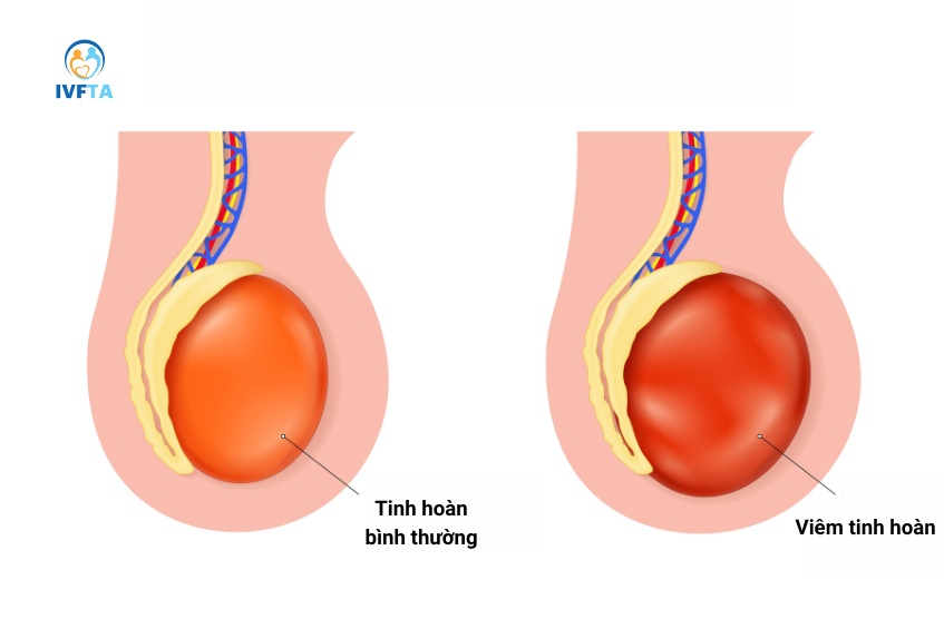 Viêm Tinh Hoàn Là Gì? Viêm Tinh Hoàn Có Quan Hệ Được Không?
