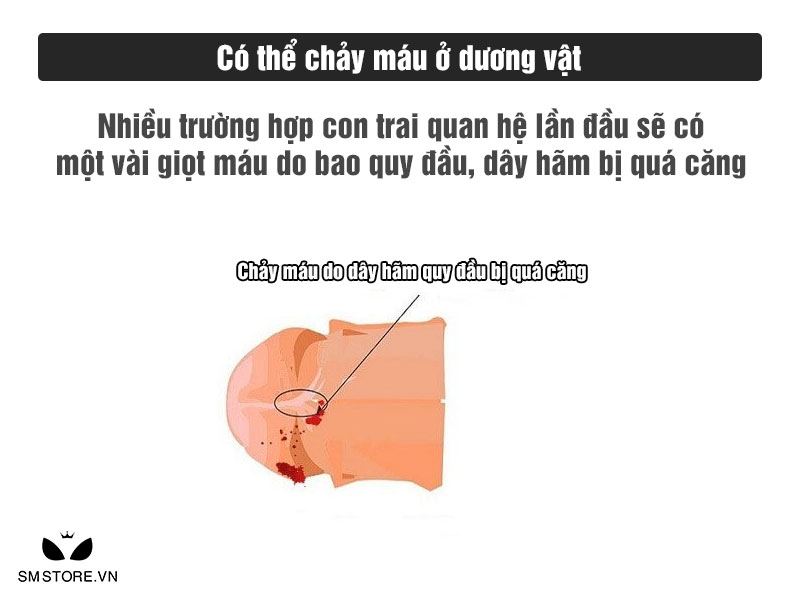 Chảy máu do dây hãm quy đầu quá căng