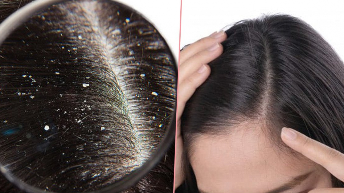 Cách khắc phục gàu trên da đầu