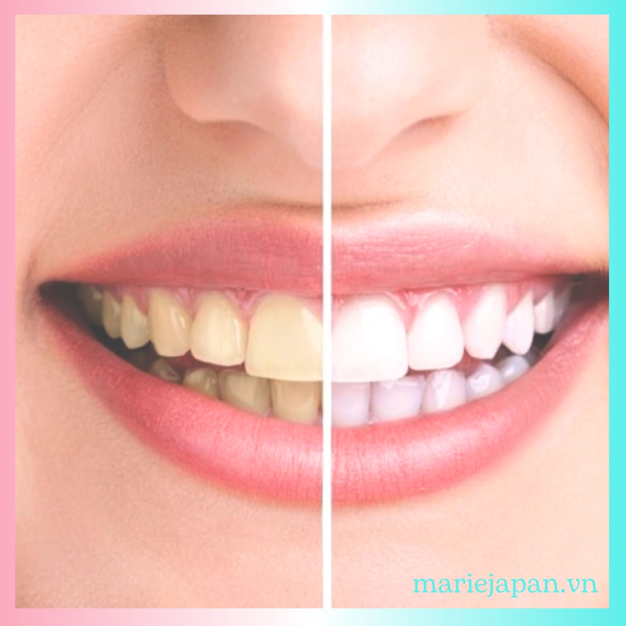 Nguyên nhân gây ra tình trạng ố vàng răng