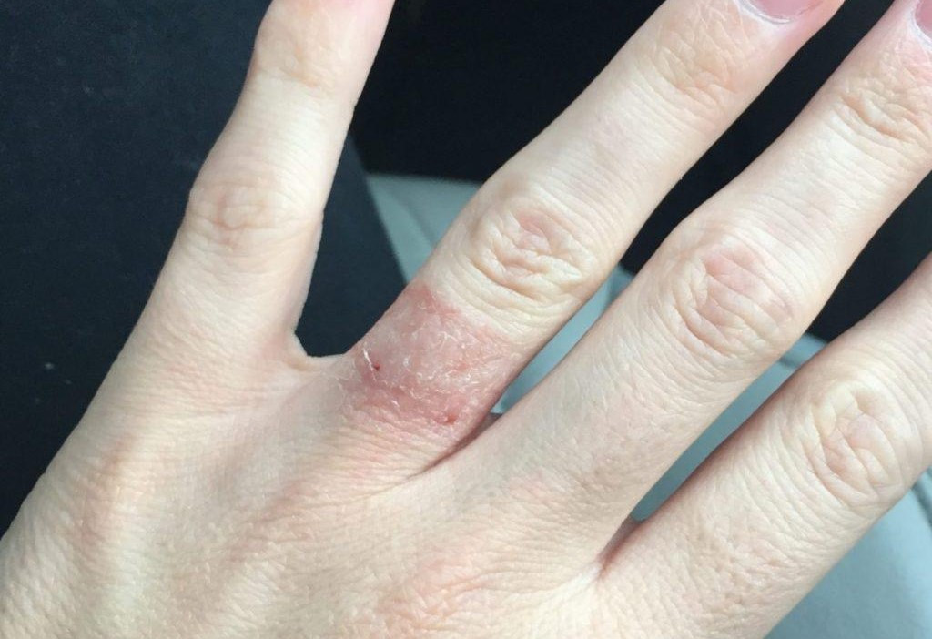 dị ứng da do đeo nhẫn