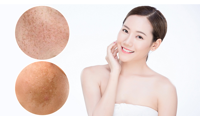 Điều trị nám, tàn nhang được xem là cần nhiều thời gian và tiền bạc