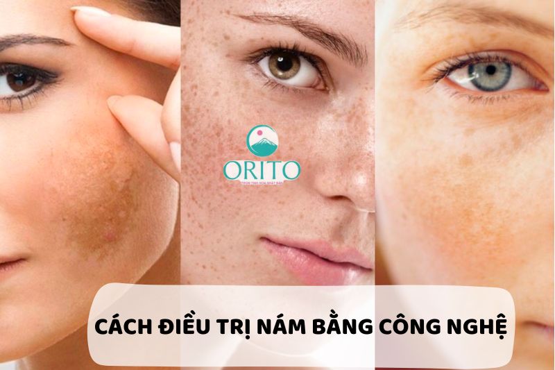 Điều trị bằng công nghệ trị nám tốt nhất hiện nay