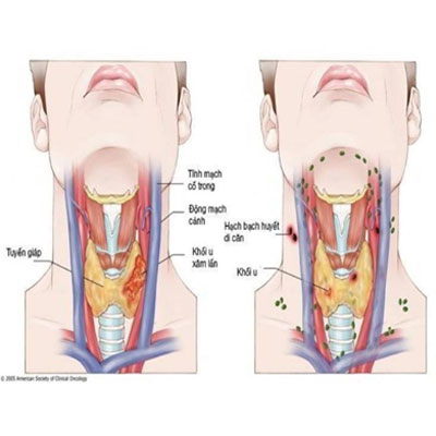 cổ họng và thực quản