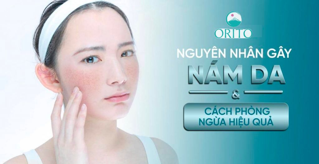 Nguyên nhân hình thành nám da