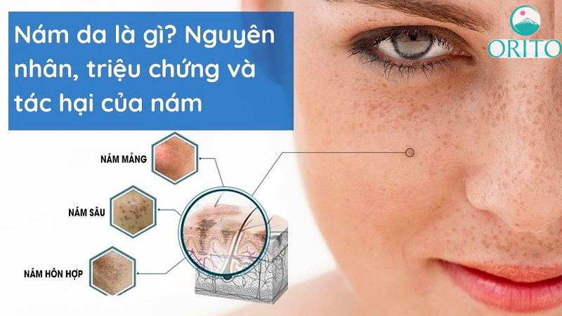 Nguyên nhân bị nám da mặt