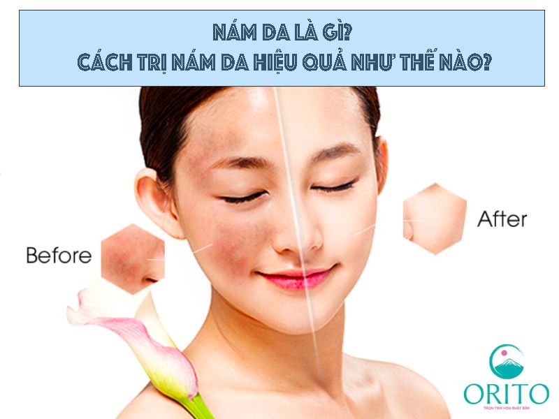 Cách diều trị nám da hiệu quả