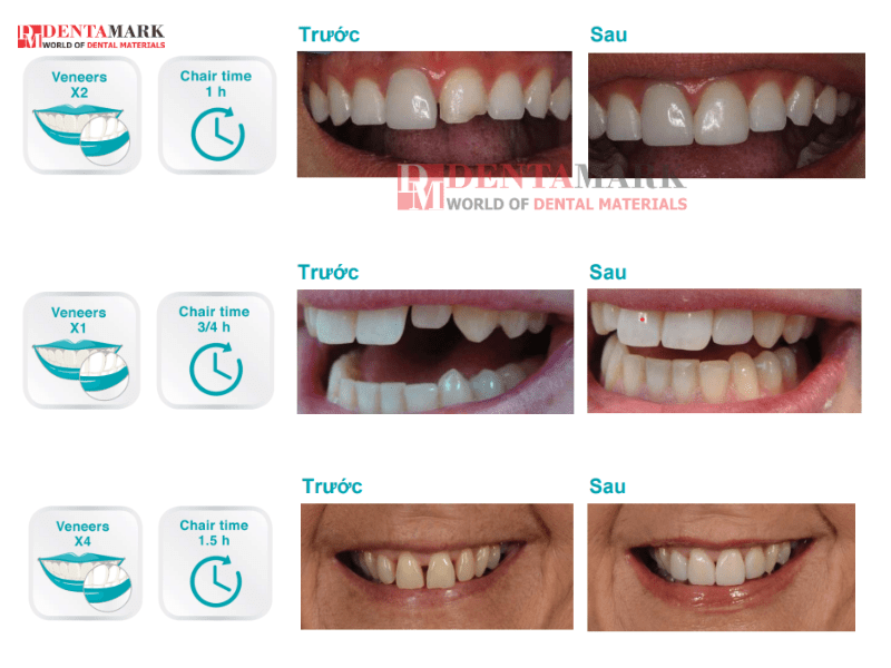 Veneer không mài răng - Bằng chứng lâm sàng 1