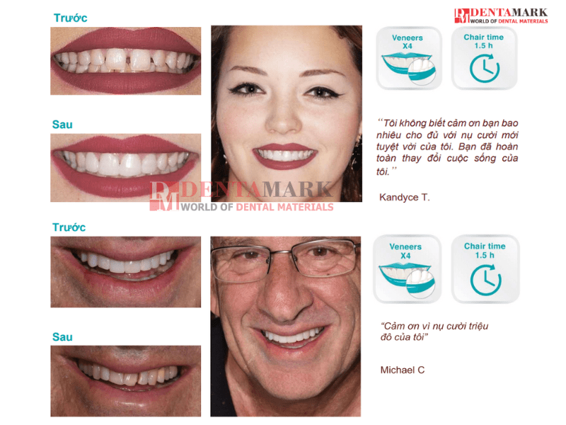 Veneer không mài răng - Bằng chứng lâm sàng 2