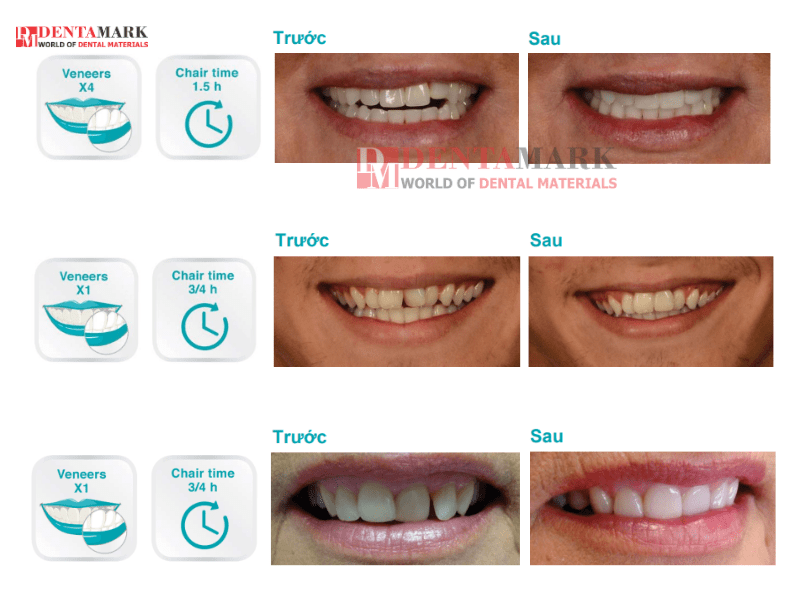 Veneer không mài răng - Bằng chứng lâm sàng 3