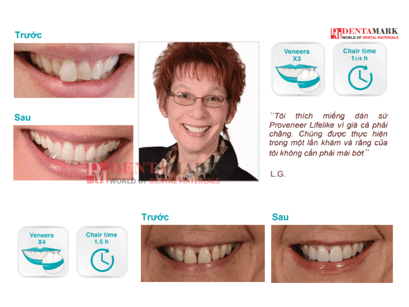 Veneer không mài răng - Bằng chứng lâm sàng 4