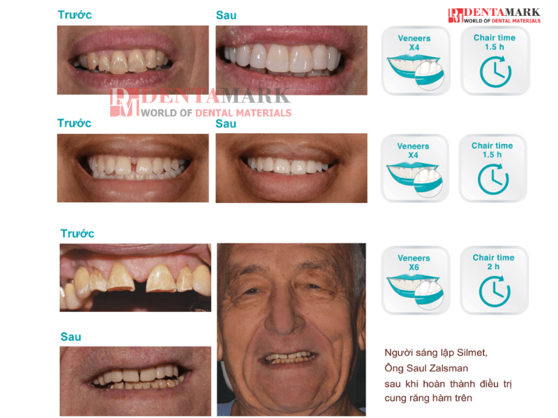 Veneer không mài răng - Bằng chứng lâm sàng 5