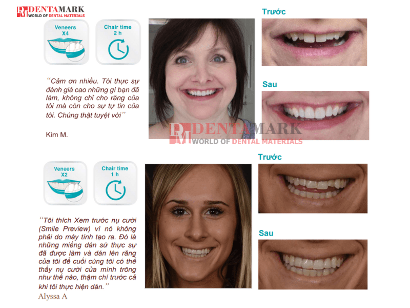 Veneer không mài răng - Bằng chứng lâm sàng 6