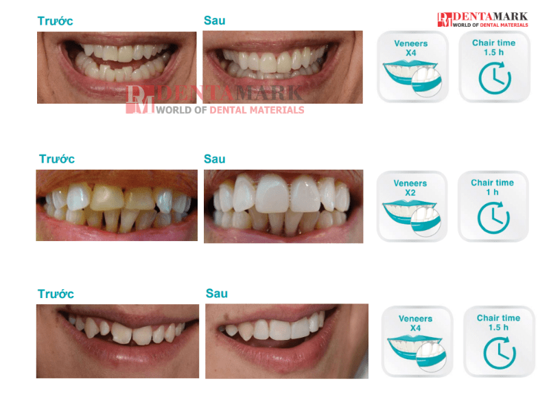 Veneer không mài răng - Bằng chứng lâm sàng 7