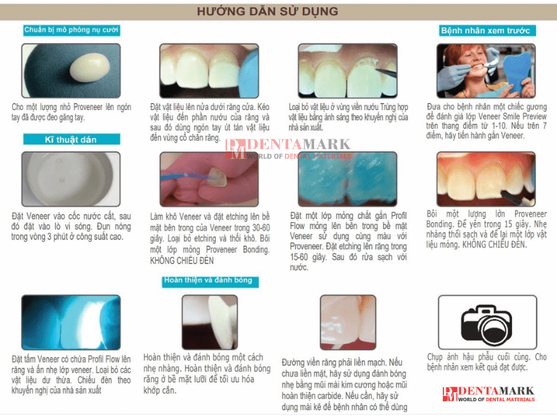 Veneer không mài răng - Quy trình thực hiện