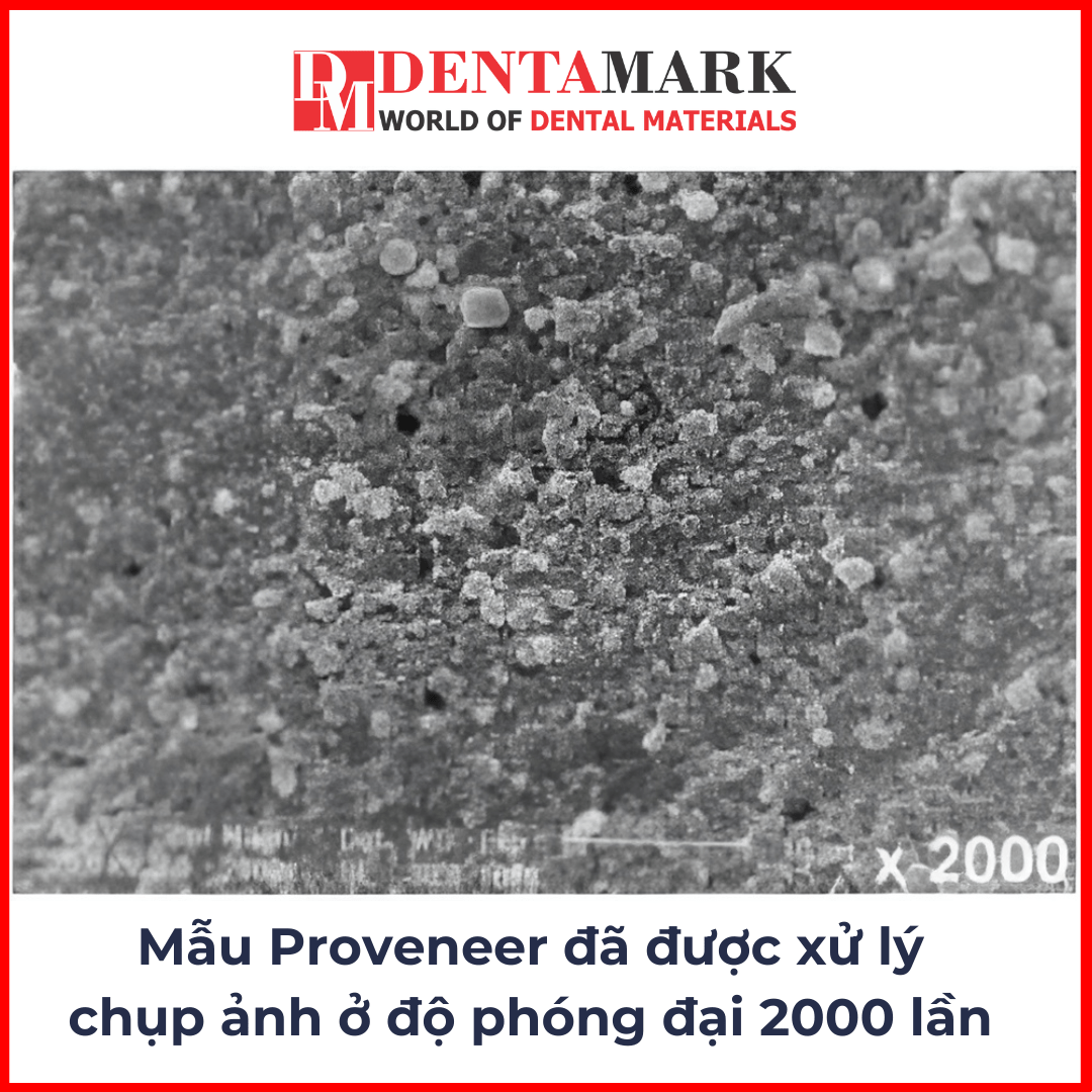 Veneer không mài răng - Soi dưới kính hiển vi