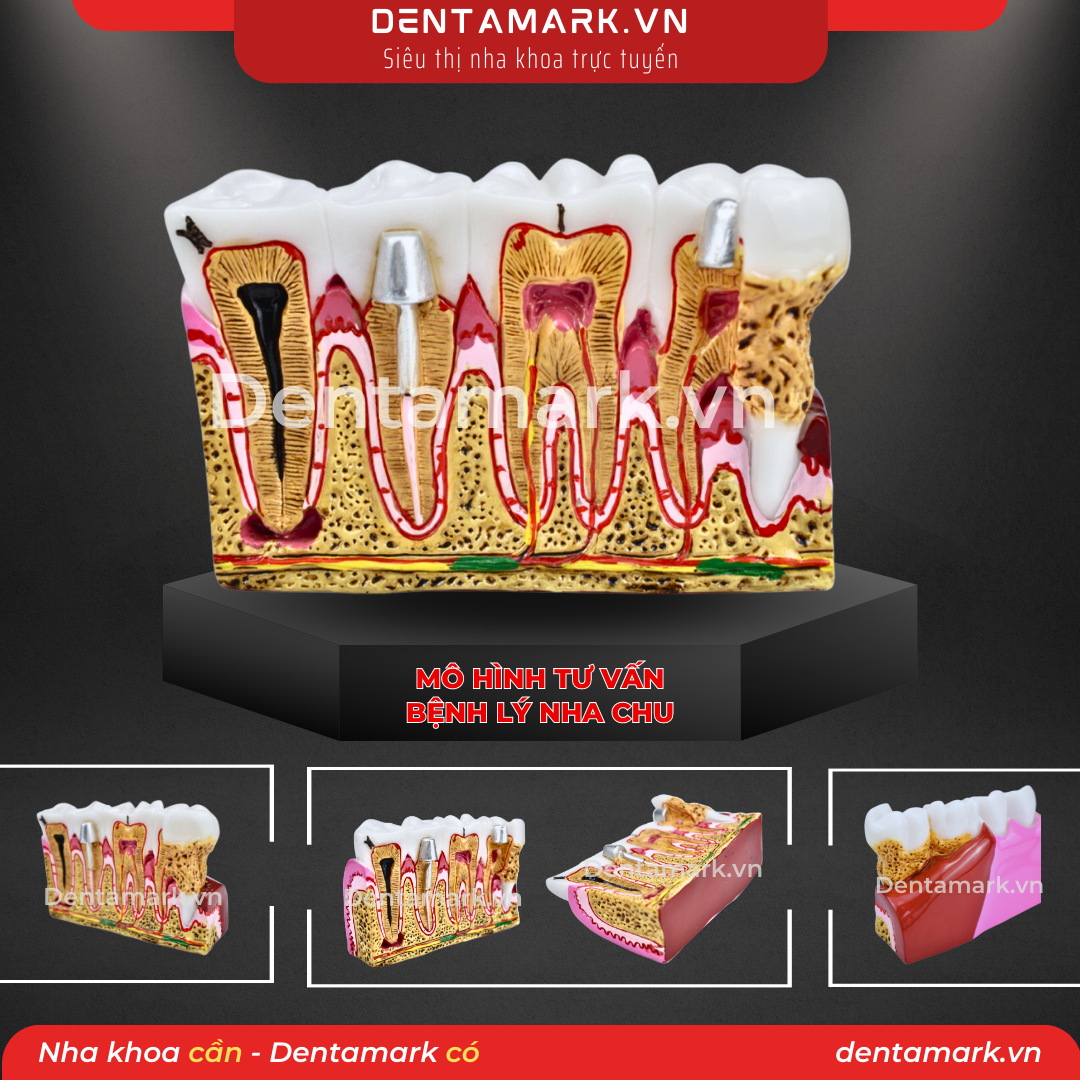 1 Mau ham tu van nha khoa, ham tu van benh nhan - Mo hinh tu van benh ly nha chu, mo hinh tu van nha chu, viem loi, noi nha, giai phau rang