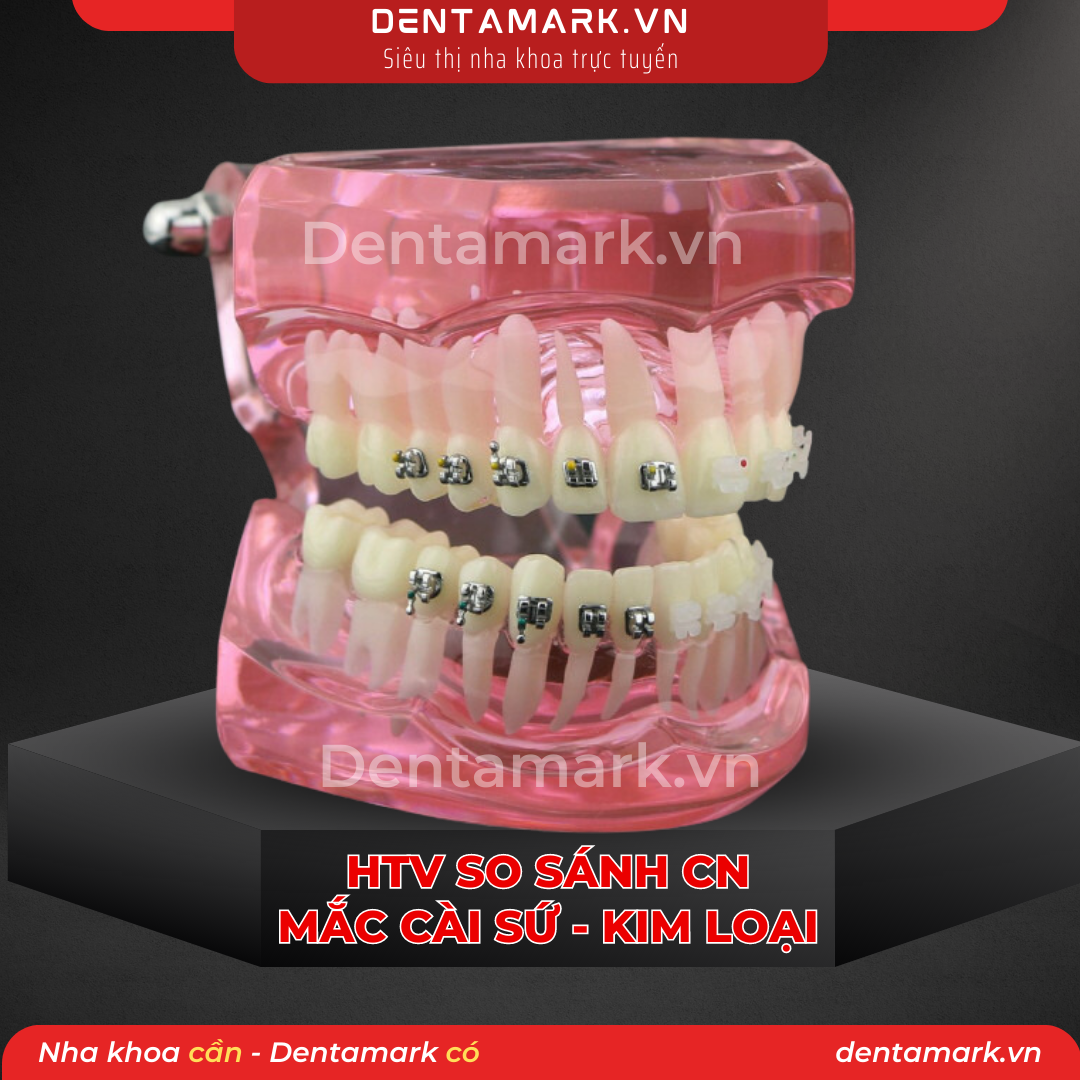 Mau ham tu van nha khoa, ham tu van benh nhan - Ham tu van chinh nha, ham tu van chinh nha mac cai kim loai, ham tu van chinh nha mac cai su, ham tu van so sanh chinh nha mac cai kim loai va mac cai su (1)