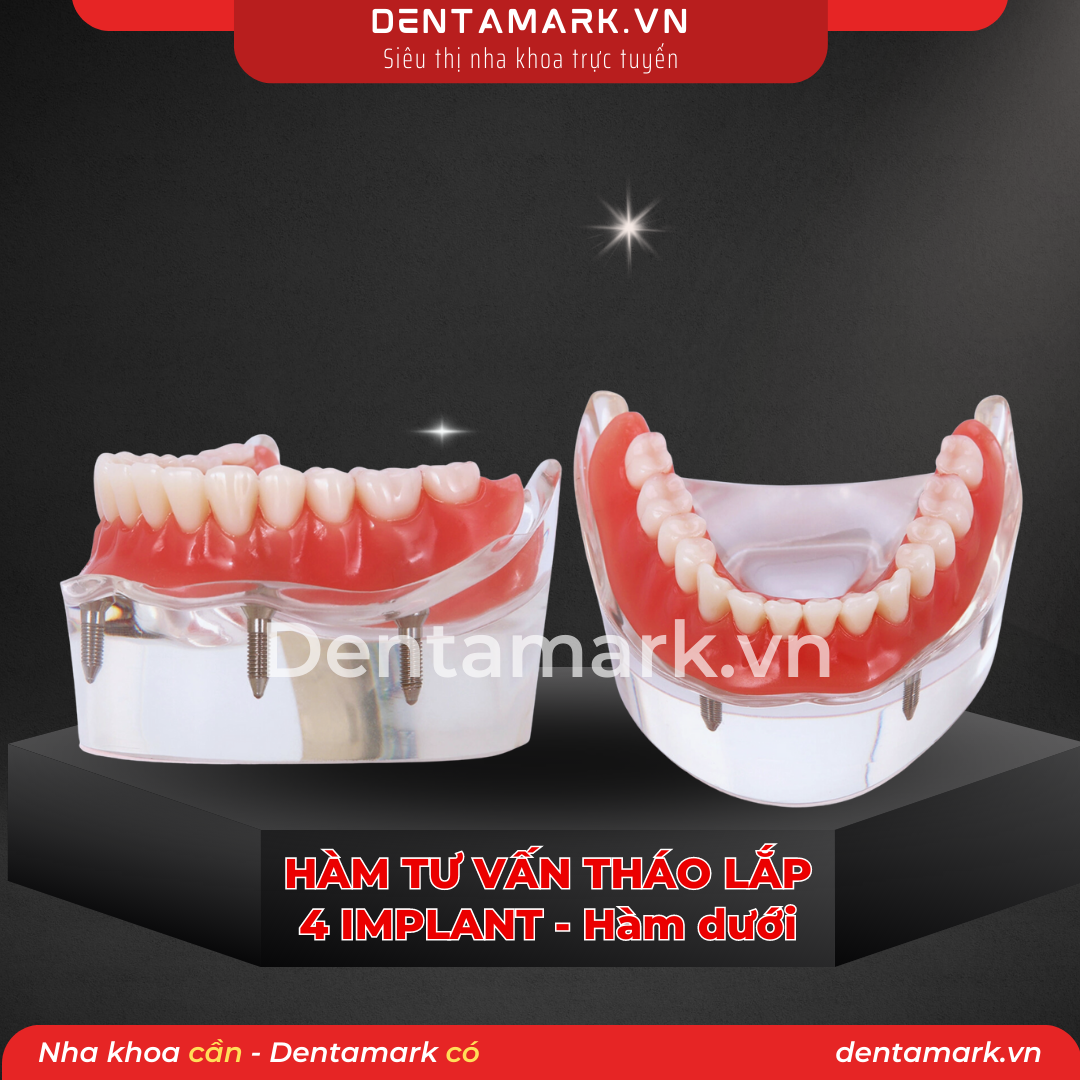 Mau ham tu van nha khoa, ham tu van benh nhan, ham tu van thao lap, ham tu van implant, ham tu van thao lap 4 implant, phuc hinh thao lap 4 implant, ham Implant all on 4