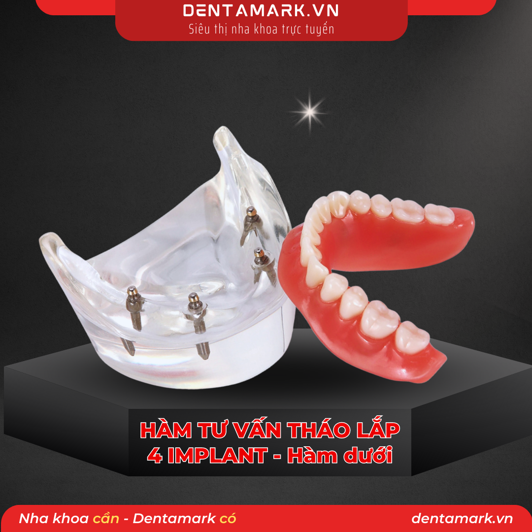 Mau ham tu van nha khoa, ham tu van benh nhan, ham tu van thao lap, ham tu van implant, ham tu van thao lap 4 implant, phuc hinh thao lap 4 implant, ham Implant all on 4