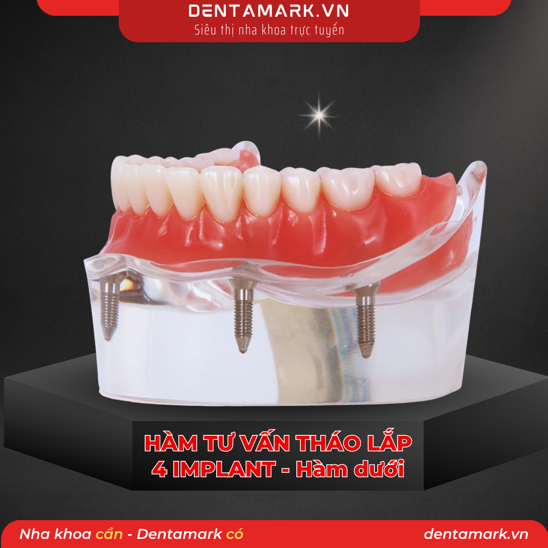 Mau ham tu van nha khoa, ham tu van benh nhan, ham tu van thao lap, ham tu van implant, ham tu van thao lap 4 implant, phuc hinh thao lap 4 implant, ham Implant all on 4