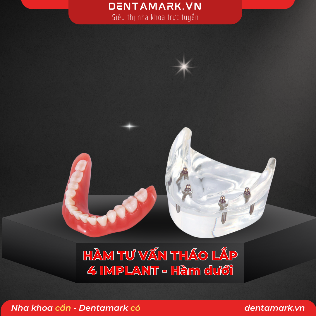 Mau ham tu van nha khoa, ham tu van benh nhan, ham tu van thao lap, ham tu van implant, ham tu van thao lap 4 implant, phuc hinh thao lap 4 implant, ham Implant all on 4