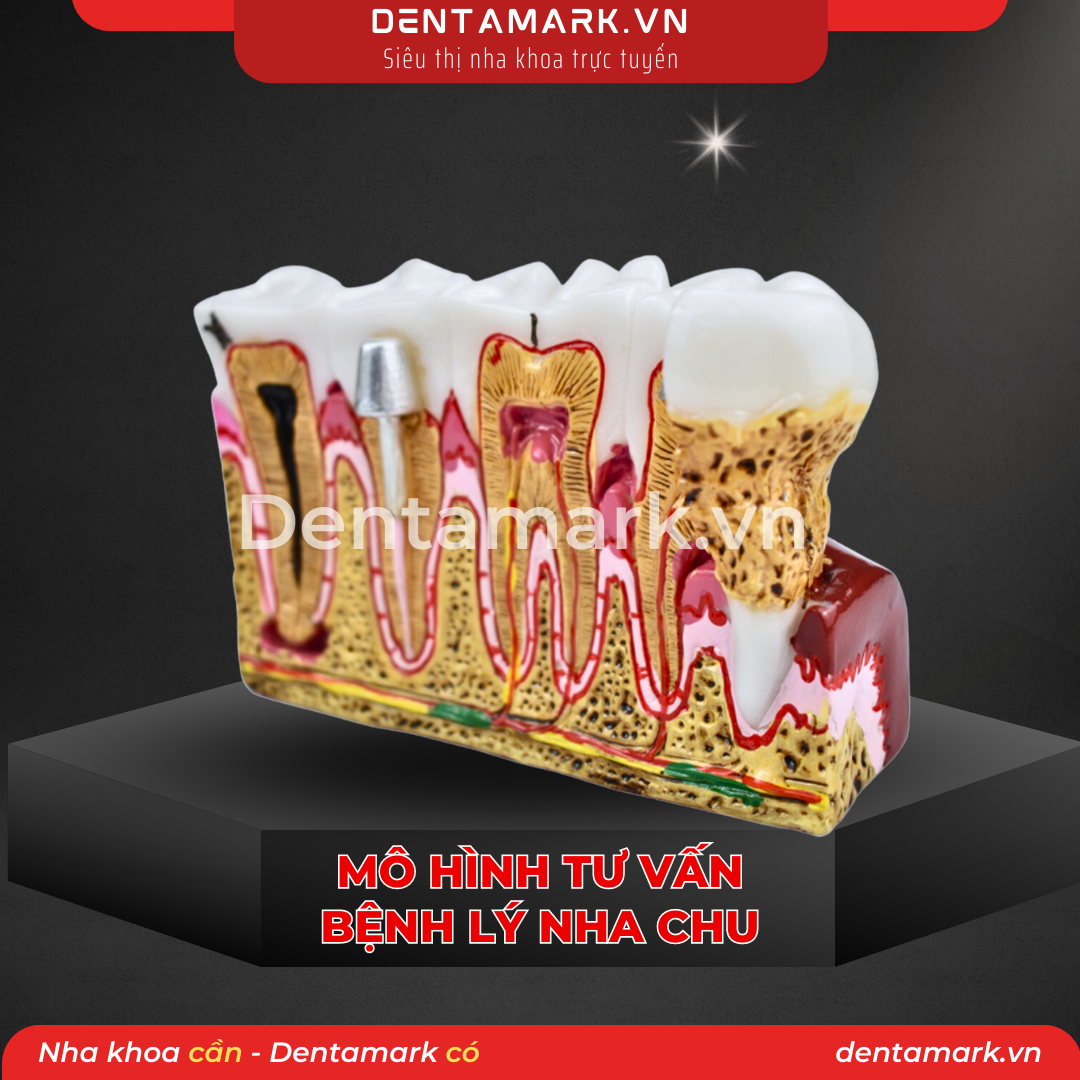 1 Mau ham tu van nha khoa, ham tu van benh nhan - Mo hinh tu van benh ly nha chu, mo hinh tu van nha chu, viem loi, noi nha, giai phau rang