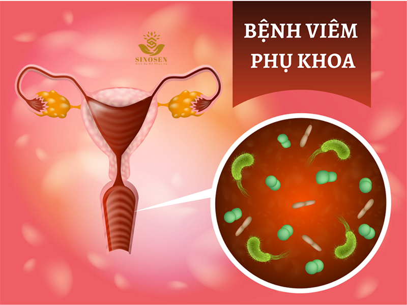 Bệnh phụ khoa thường gặp ở phụ nữ