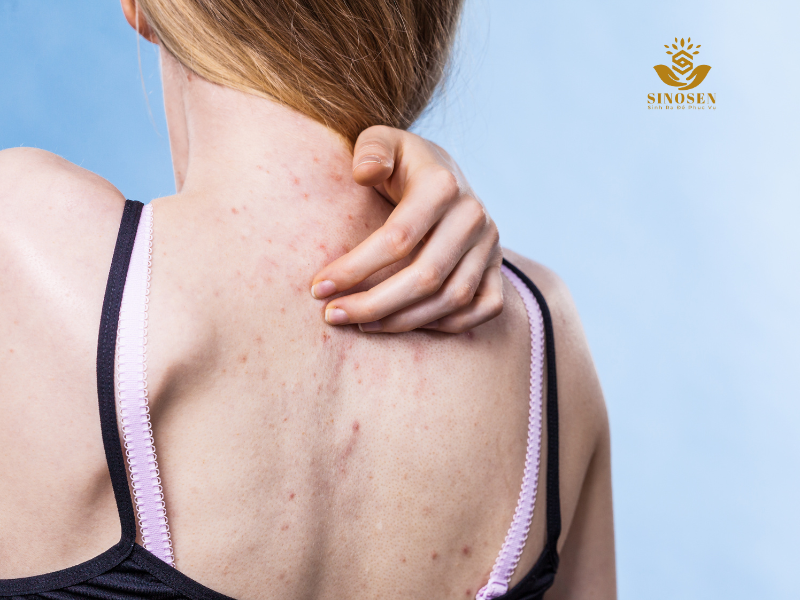 cách trị mụn lưng