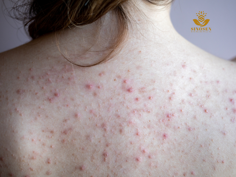 Nguyên nhân xuất hiện mụn lưng