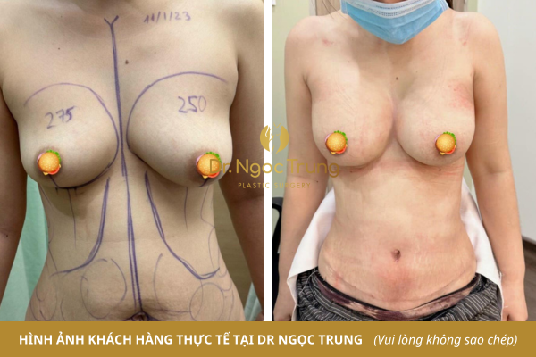 Hút mỡ, tạo hình thành bụng