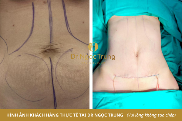 Hút mỡ, tạo hình thành bụng