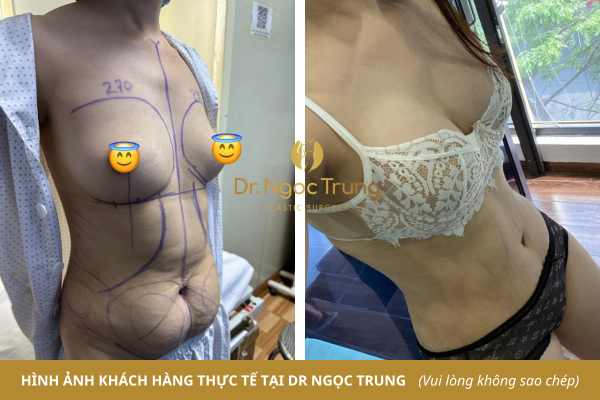 Hút mỡ, tạo hình thành bụng