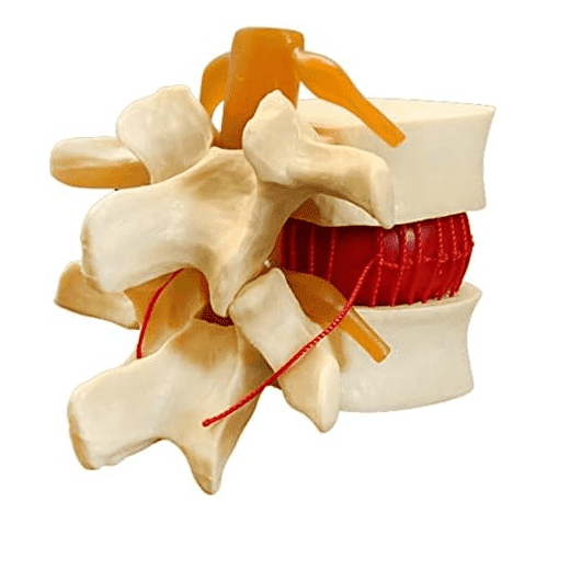 Mô hình bệnh lý thoát vị đĩa đệm