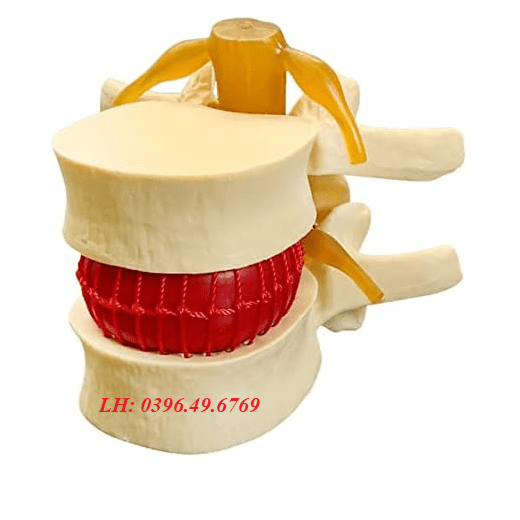 Mô hình thoát vị đĩa đệm